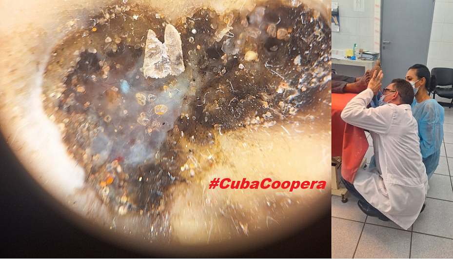 Dermastocopia en paciente africano